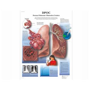 Póster laminado 50 × 67 cm - Doença Pulmonar Obstrutiva Crónica (DPOC)
