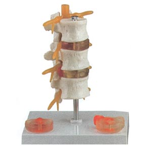Modelo de patología de hernia