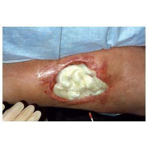 3M™ Tegaderm™ Alginate Apósito de alginato de calcio de alta integridad