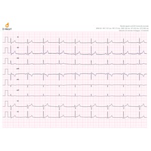 Nato bel monitor ecg portatile per cuore Bluetooth wireless senza elettrodi  metallici Monitoraggio ECG per uso domestico Registrazione Android iOS