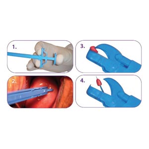 Pince à biopsie Gyn & Push stérile - 21,5 cm