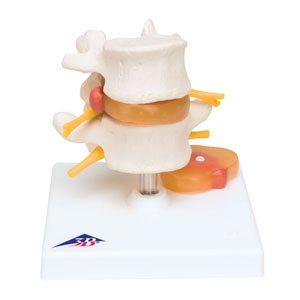 Modello di vertebre lombari con ernia del disco