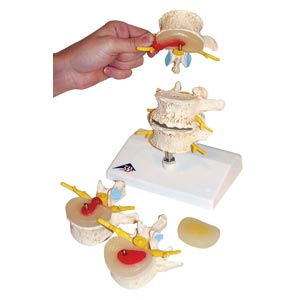 del disco intervertebrale e degenerazione della vertebra