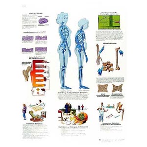 Poster laminato 50 x 67 cm - Osteoporosi 