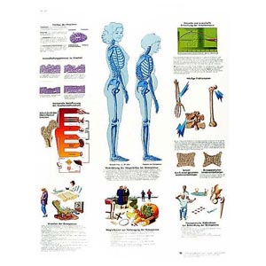 laminato 50 × 67 cm - Osteoporosi 