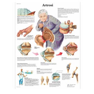 laminato 50 × 67 cm - Artrosi 