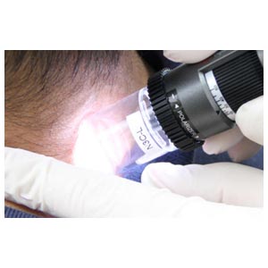 Cappuccio trasparente per Video dermatoscopio polarizzato Dino-Lite