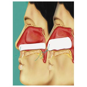 Raucocel Tampone nasale retto con filo