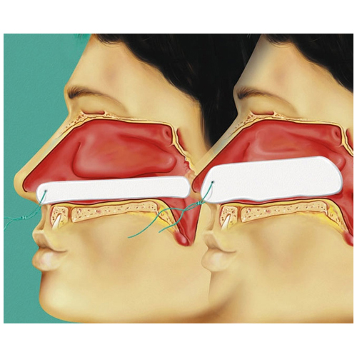 Tamponi nasali Raucocel per epistassi 