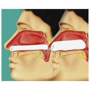 Tampones nasales Raucocel para epistaxis - varias medidas